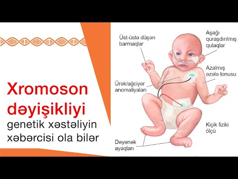 Video: Xromosom anomaliyaları müalicə edilə bilərmi?