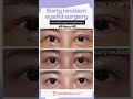 Early revision eyelid surgery at any time you dont have to wait for 6 months