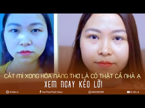 Video Cắt mí xong hóa nàng thơ là có thật - Cắt mí Dr. Hải... - youtube