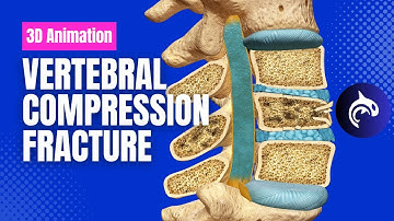 See how Osteoporosis Affects the Spine: Vertebral Compression Fractures