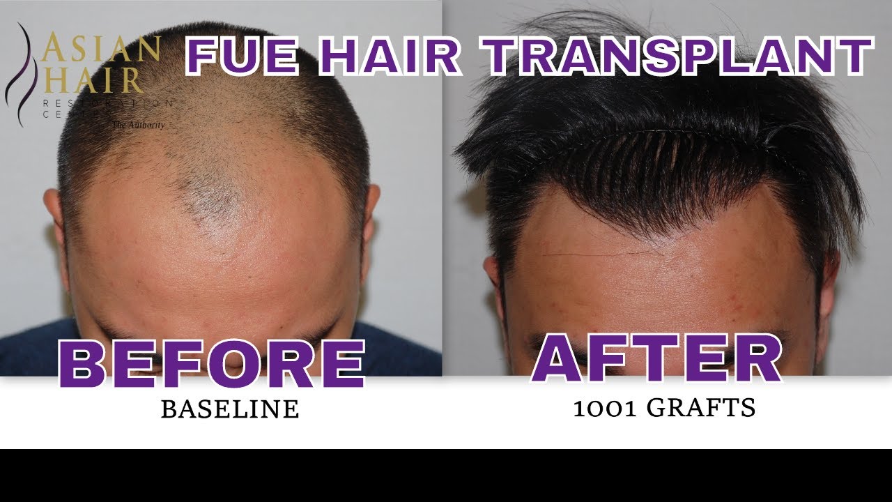 FUE Hair transplant for thinning hair in Pasig, Manila,Philippines