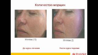 Лаеннек - гидролизат плаценты человека.avi
