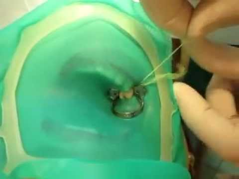 uso da tira dental elastica na endodontia ( tira+) - YouTube