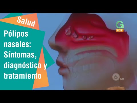 Vídeo: Cáncer De Pólipos Nasales: Síntomas, Diagnóstico Y Tratamiento