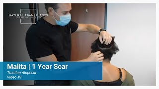Minimal Scaring After 1 Year for Traction Alopecia Patient | Dr. Siegel (Malita)