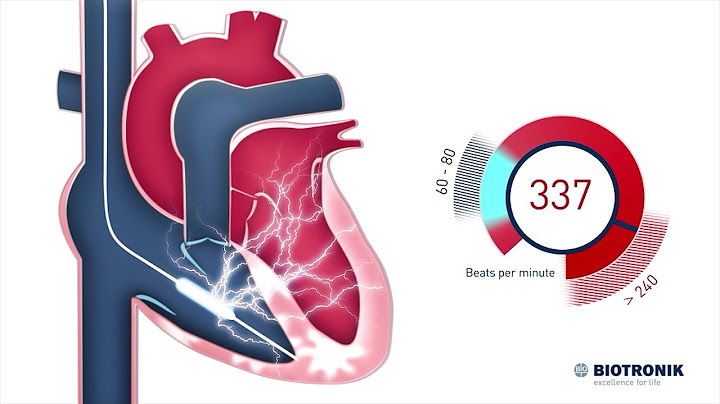 Desfibrilador cardioversor implantable - Cómo funciona