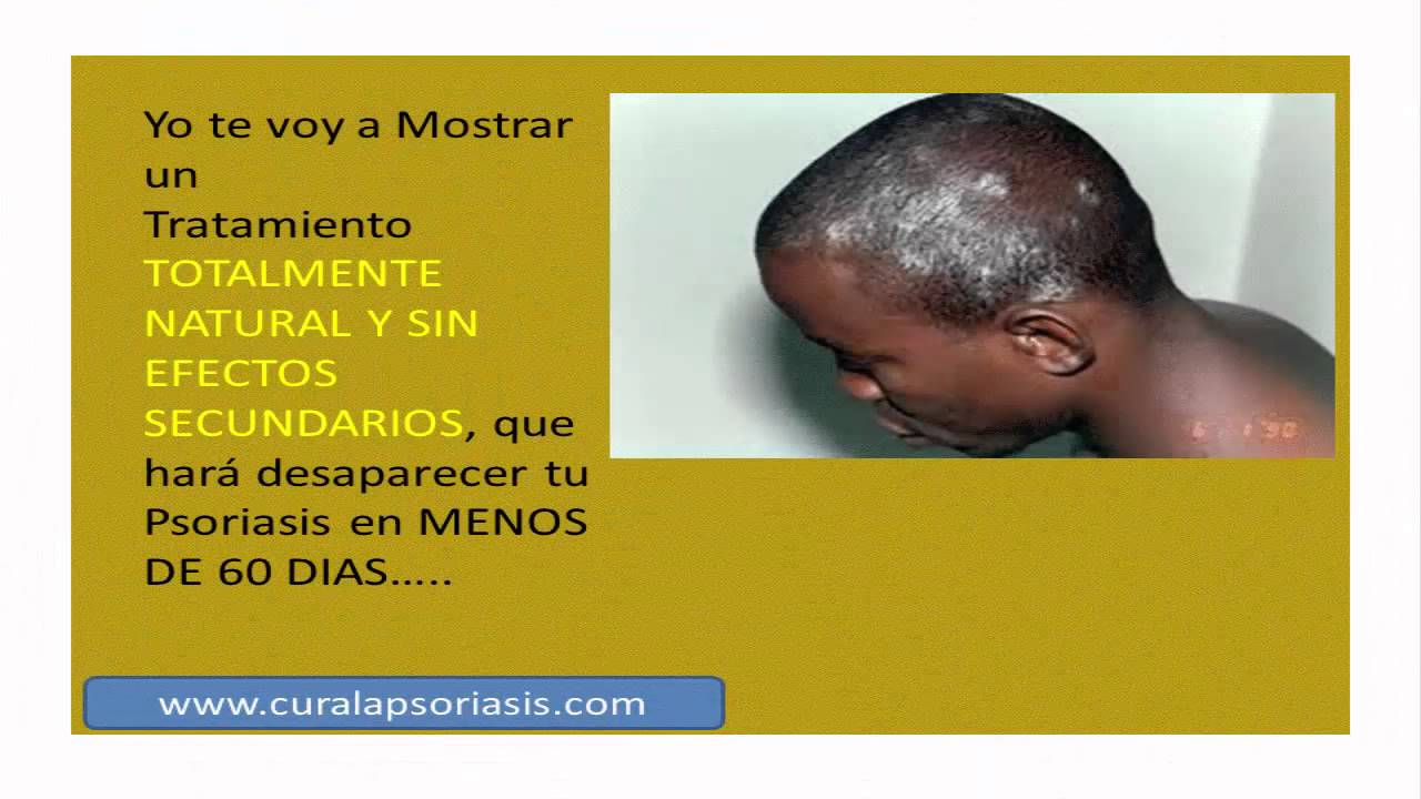 Cómo tratar la psoriasis del cuero cabelludo Cómo tratar la psoriasis del cuero cabelludo