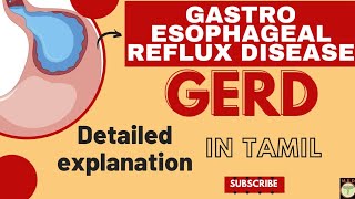 GASTRO ESOPHAGEAL REFLUX DISEASE | GERD |gerd therapeutics pharmacologymedicine stomach tamil