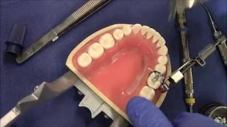 Restoration in Amalgam - #30 MO