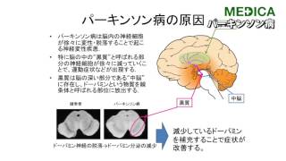 【MEDICA】「パーキンソン病」　川崎医科大附属病院神経内科 三原雅史部長