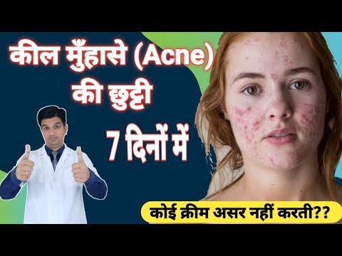 Pimple गायब हो जाएंगे | Adapalene clindamycin gel | Cream for Acne and