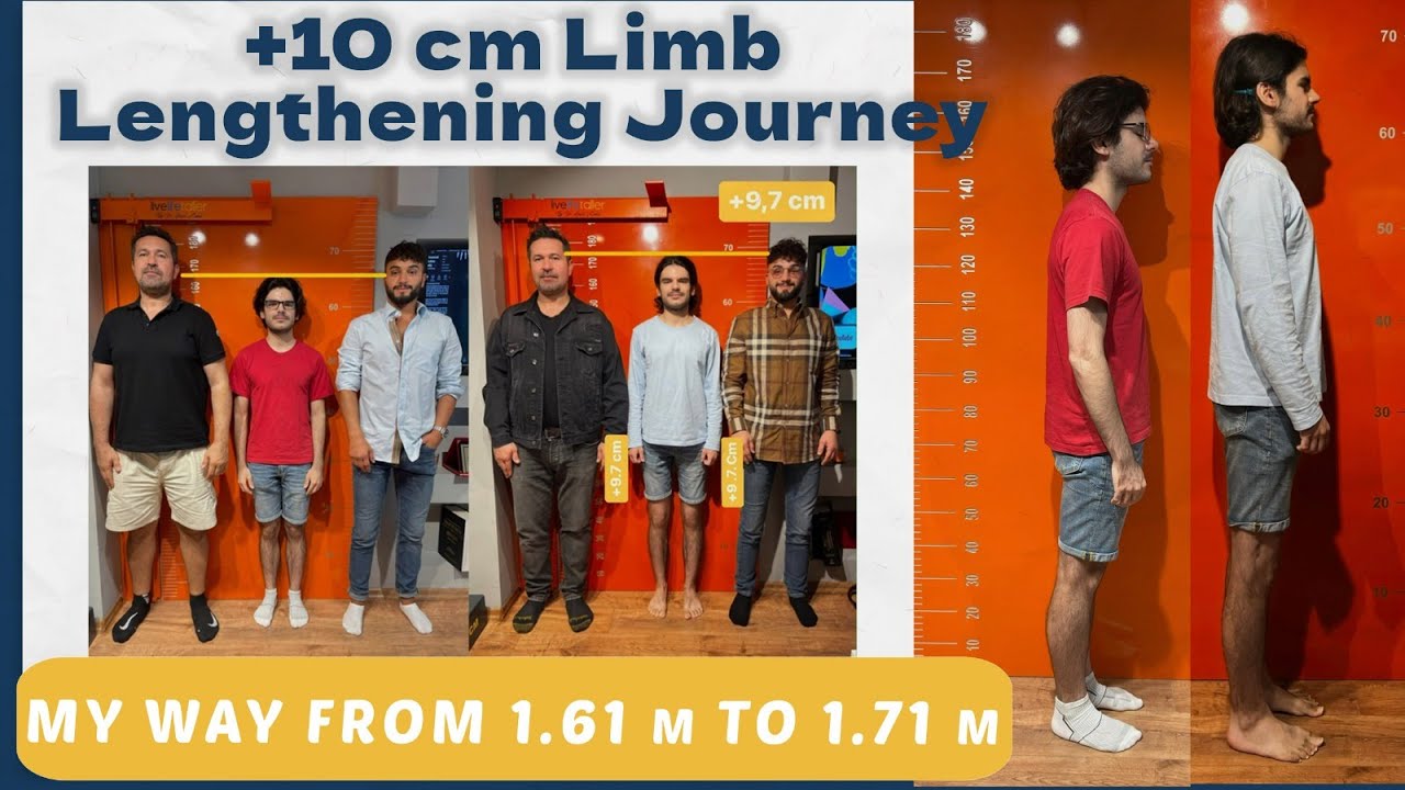 10-cm-limb-lengthening-journey-my-way-from-1-61-m-to-1-71-m-youtube