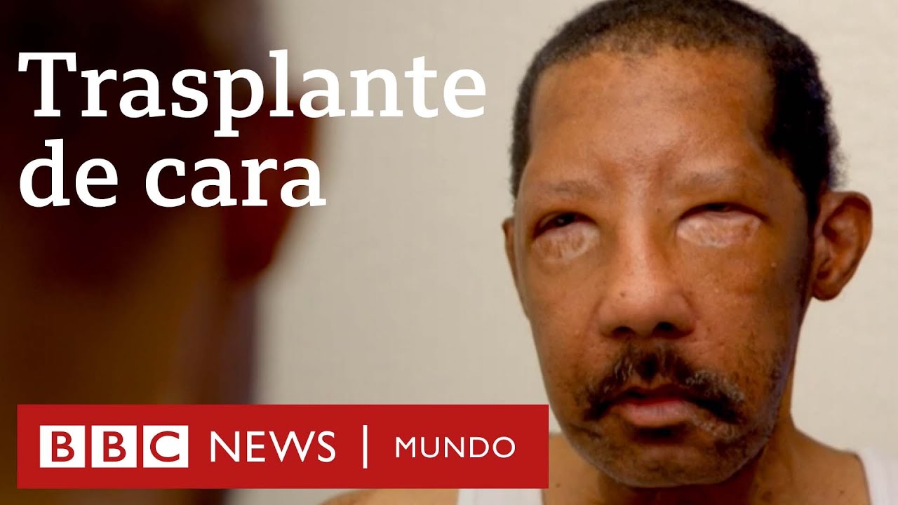 Mi nueva vida con el rostro de un extraño | Documental BBC
