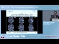 Maximilian schulz on cercare perfusion software for cns tumors  neurorads 2022