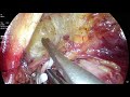 Laparoscopic posterior exenteration  for  rectal cancer with incisional hernia repair