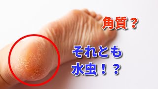 かかとのガサガサの改善方法 水虫なのか角質を見分けるポイントは 豆知識 Youtube