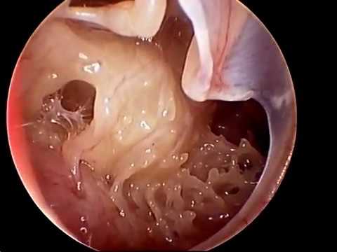 anatomy of middle ear in perforated tympanic membrane otoendoscopy