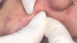 Full Blackhead Popping Video - HOT 2019 - Part 1