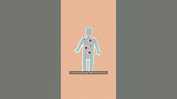 Cách phân biệt tai biến mạch máu não và xuất huyết não #kiênthưcsưckhoe #chămsocsưckhoe  #giadinh