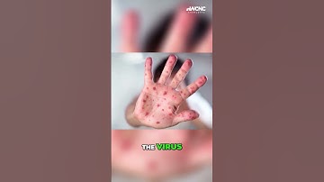 Can you get measles if you