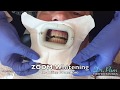 Teeth Whitening Video | In-Office ZOOM Whitening Step-by-Step with Results