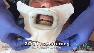 Teeth Whitening Video | In-Office ZOOM Whitening Step-by-Step with Results