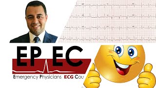 #EPEC ECG Cases (Case 06). How to interpret ANY ECG easily.