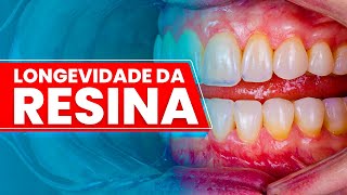 Longevidade Da Resina - Mylene E Renato