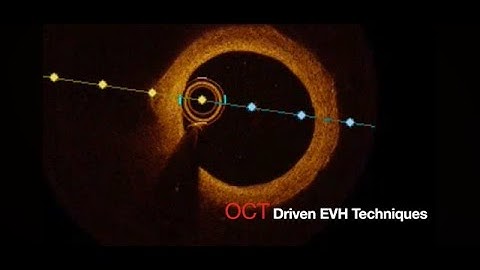 OCT Driven EVH Techniques: Sweetspot 2.0 - Leaving Adventitia and Fat on Vein