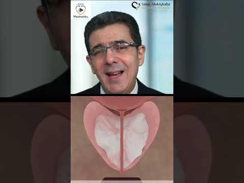 كيفية علاج البروستاتا بالايكوليزر في دقائق د سمير عبد الغفار