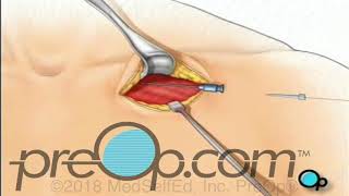 Permanent Pacemaker Implant Surgery - PreOp®  Patient Education