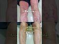Steroid-Free Psoriasis Solution That Actually Works #shorts