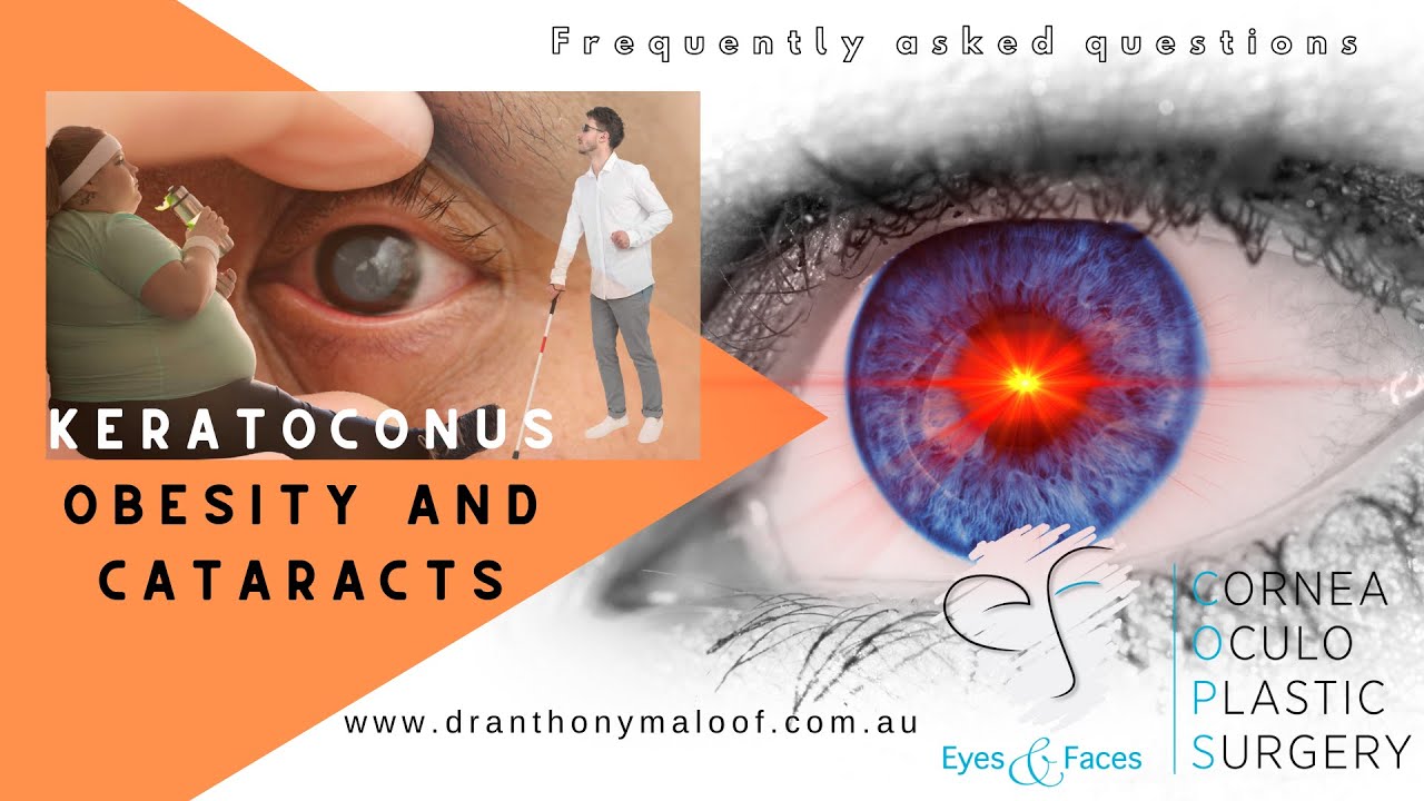 FAQ Keratoconus Obesity and Cataracts Dr Anthony Maloof, Sydney