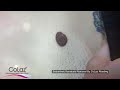 Seborrheic keratosis removal by colaz reading