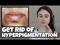 GET RID OF HYPERPIGMENTATION AROUND THE MOUTH| DR DRAY