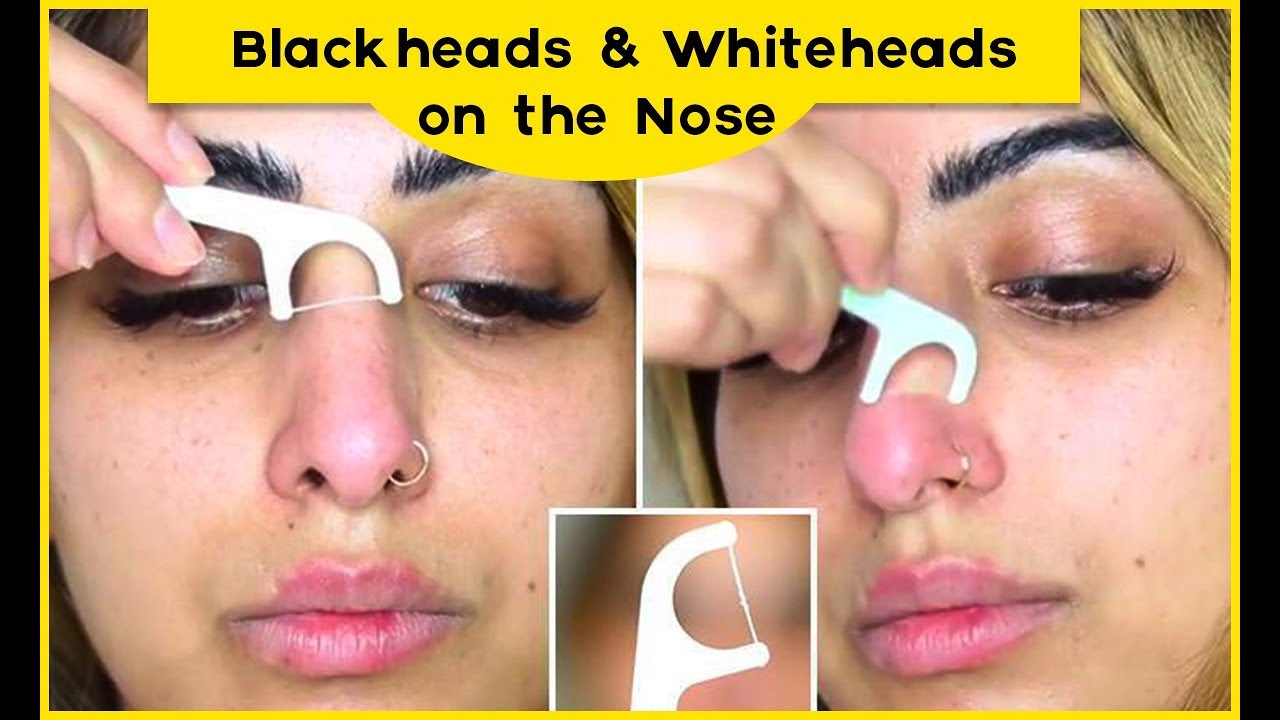 5 Ways to Get Rid of Blackheads & Whiteheads on the Nose Easy - Healthy ...