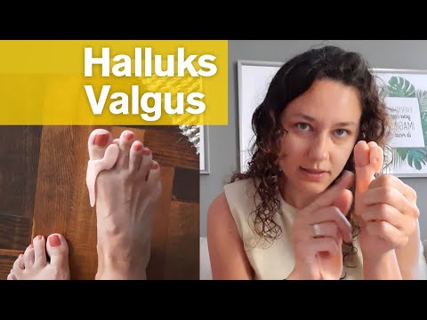 Ayak kemiği çıkıntısı (Halluks Valgus) ve Tedavi Sürecim  #halluksvalgus  #silikonmakara