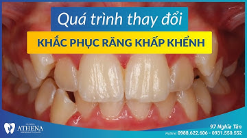 Niềng răng mắc cài kim loại - khắc phục răng khấp khểnh | Nha khoa quốc tế Athena