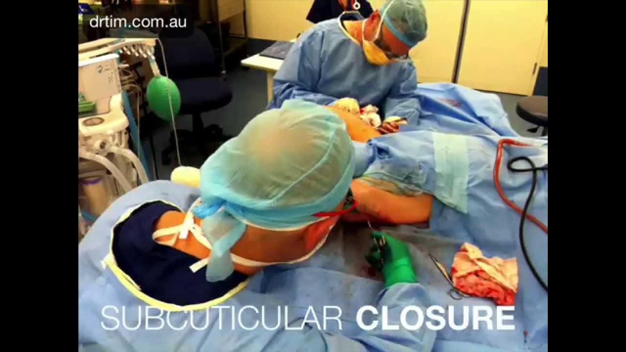 Brachioplasty for "Bingo Arms" YouTube