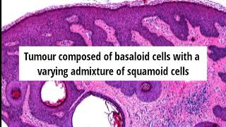 Pathology of Seborrheic Keratosis by Dr Sampurna Roy MD (dermpath, dermatopathology)