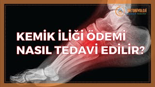 KEMİK İLİĞİ ÖDEMİ NASIL TEDAVİ EDİLİR? Resimi