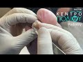 Big Toe Callus|Ποδολόγος|Ποδίατρος|Κέντρο Ποδιού Podiatry|Podiatrist #κεντροποδιου #calluses #corn