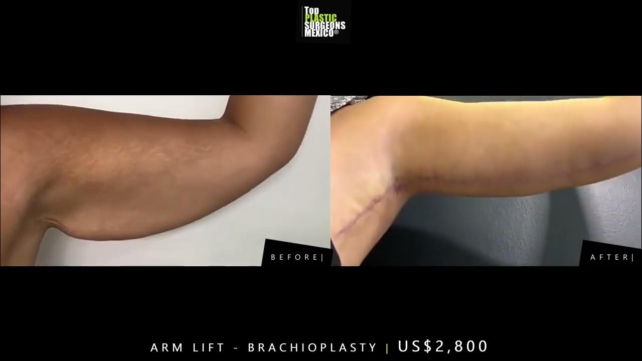 US2,800 Arm Lift in Mexico YouTube