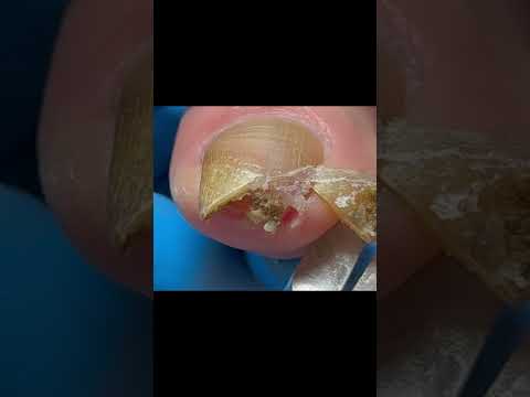 Long, Yellow, Curly Toenails, Gently Trimmed #satisfying #nails