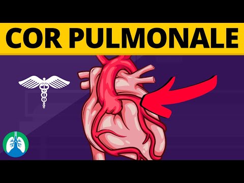 Video: Wat is pulmonale pneumatocele?