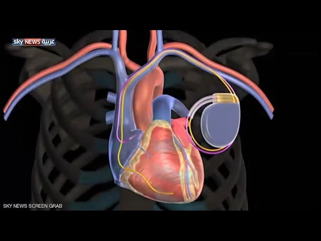 ضربات القلب منظم بطارية جهاز تنظيم