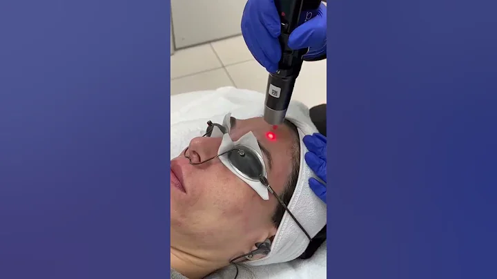 PicoSure Laser Treatment for dark spots #shorts #satisfying #antiaging #lasertreatment #picosure