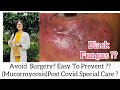 Mucormycosis treatmentsblack fungus top5homeopathic medicine  homeopathic anti fungal dr rukmani