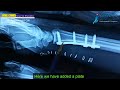 Wrist Fracture  - 1 : Dr Ashwani Maichand