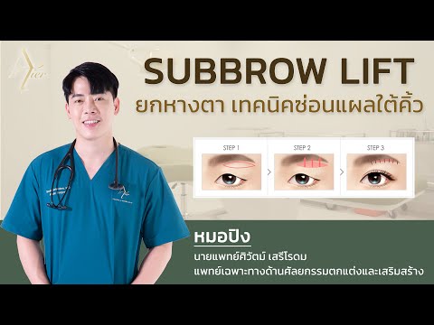 Subbrow Lift ยกหางตา เทคนิคซ่อนแผลใต้คิ้ว